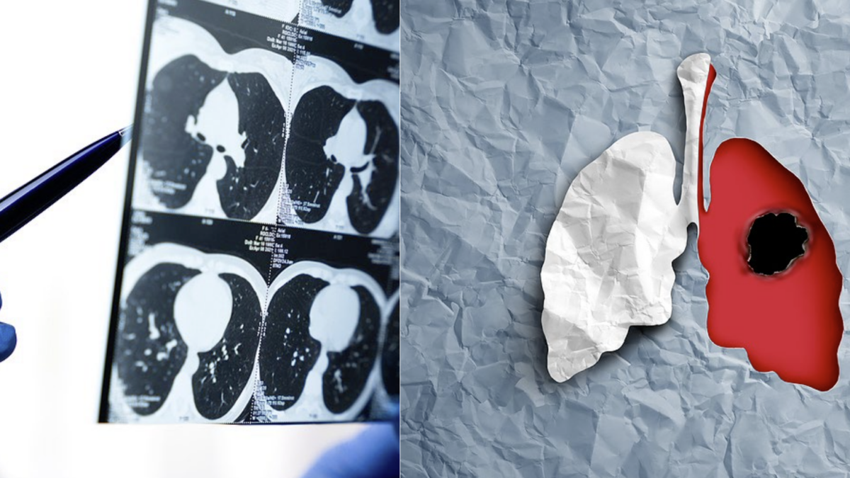 Les coûts de l'absence de dépistage du cancer du poumon