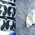 Les coûts de l'absence de dépistage du cancer du poumon