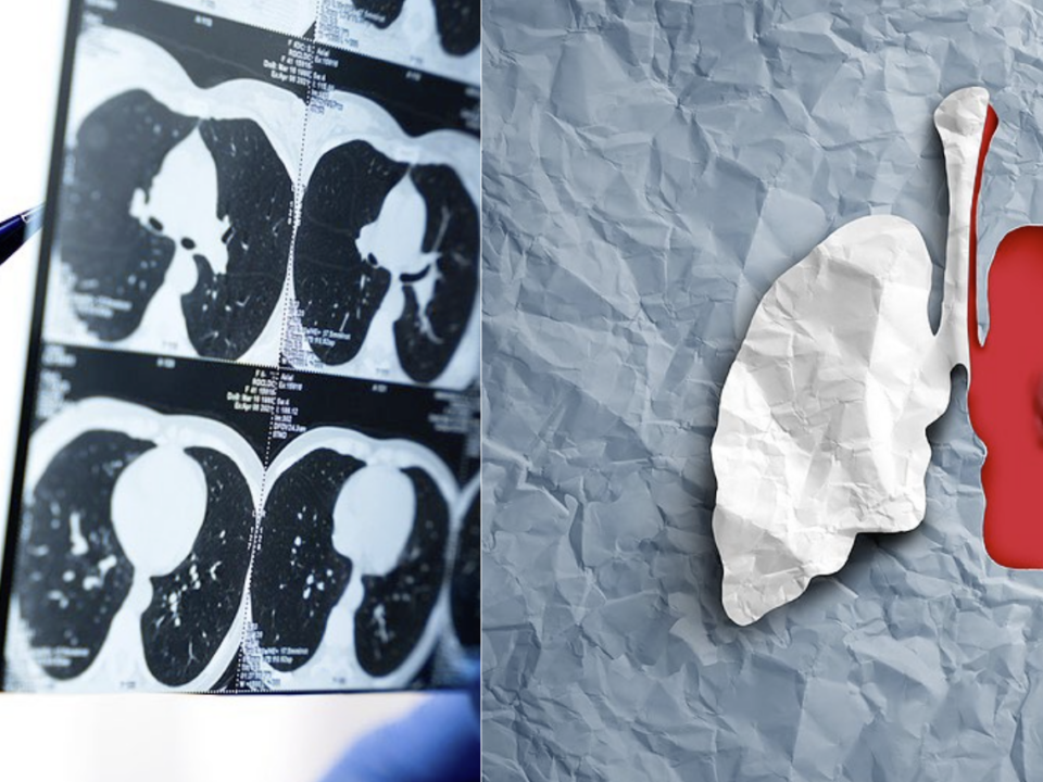 Les coûts de l'absence de dépistage du cancer du poumon